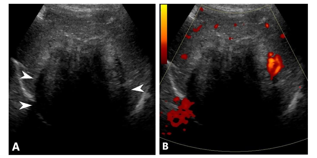 Figure 1. (A) Grayscale ultrasonography shows a large hepatic mass with predominantly hypoechoic content and significant posterior acoustic shadowing (arrowheads). (B) Color Doppler US shows scant peripheral vascularity with no significant internal vascularity.
