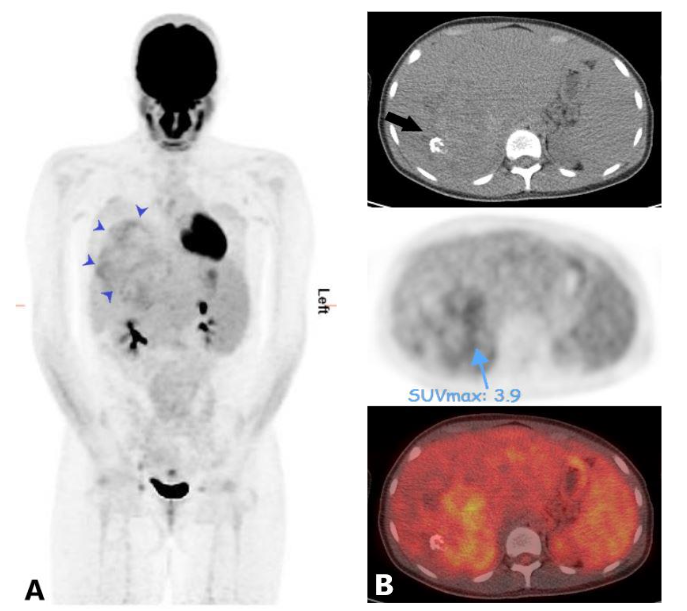 Figure 3. Maximum intensity projection (MIP) of FDG PET (A) shows mild to moderate uptake within the hepatic mass (blue arrow heads) and otherwise normal biodistribution of the tracer throughout the body with no PET findings of distant metastasis. Fused axial images of FDG PET and CT scan (B) show the most FDG avid areas of the mass. Note a cross-calculation in the mass on the non-contrast (C) scan image.