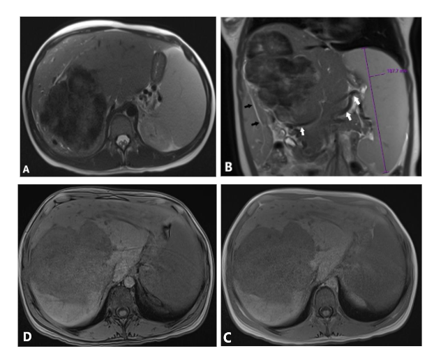 Figure 2. (A, B) Axial and coronal views of T2 weighted images (T2WI) show predominantly hypointense large mass. The intrahepatic mild biliary dilation distal to the large mass (black arrows), splenomegaly, and multiple signal void collateral vessels (white arrows). In-phase (IP) and out-of-phase (OP) images do not show signal drop on out-phase image to suggest fat component. Diffusion weighted image (DWI) and Apparent Diffusion Coefficient (ADC) show predominantly T2 blackout pattern (white arrowheads) and mild T2 shine-through centrally.