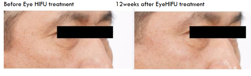 Before Eye HIFU treatment