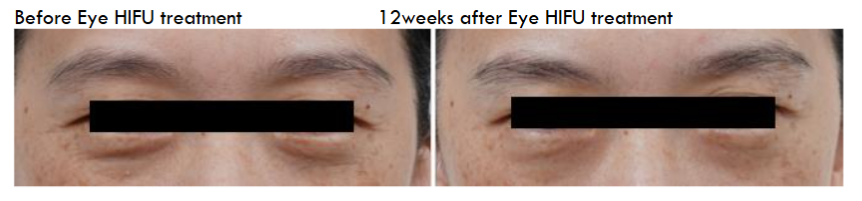 12 weeks after Eye HIFU treatment