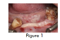 Figure 1- Pre-op (Intra oral picture)