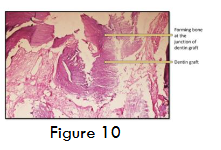 Figure 10- Bone formation at the junction of dentin grafting at 4 months