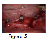 Figure 5- Implants placed in position