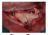 Figure 7- Alloderm® GBR placed and secured with tenting screws.