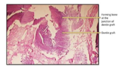 Figure 10- Bone formation at the junction of dentin grafting at 4 months