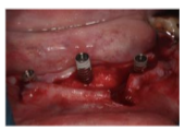 Figure 5- Implants placed in position
