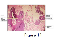 Figure 11- Remnant of Alloderm® GBR and dentin graft at 4 months