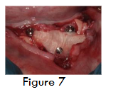 Figure 7- Alloderm® GBR placed and secured with tenting screws.