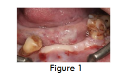 Figure 1- Pre-op (Intra oral picture)