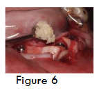 Figure 6- Dentin graft placement