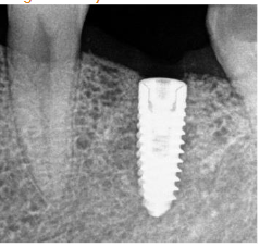 Figure 5: Implant placement done