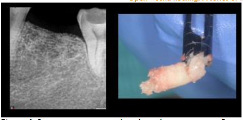 Figure 4: Bone regeneration and implant placement site at 5 months