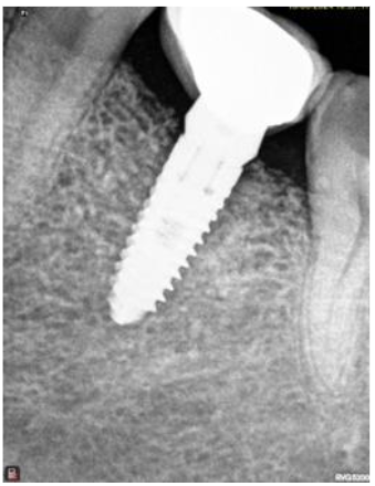 Figure 6: Implant restored with crown