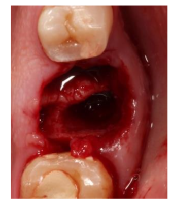 Figure 1: Socket after immediate extraction