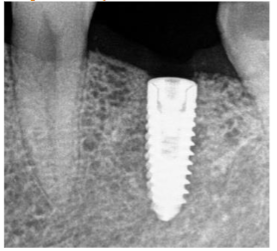 Figure 5: Implant placement done