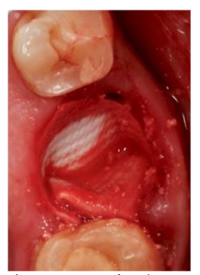 Figure 2: Bone graft and membrane placed