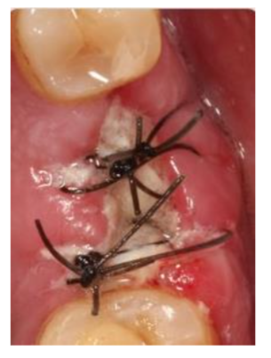 Figure 3: At suture removal