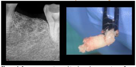 Figure 4: Bone regeneration and implant placement site at 5 months