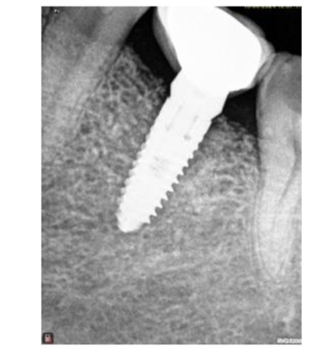 Figure 6: Implant restored with crown