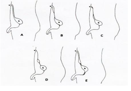 Figure 1. Classification system that categorizes urachal remnants into five types: Blichert-Toft et al.