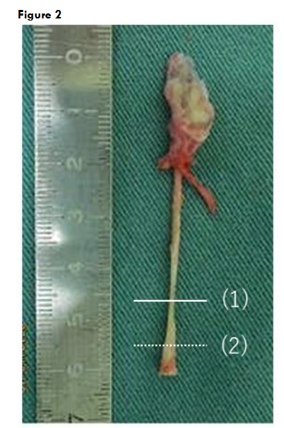 Figure 2. The excised specimen (case 1): Histological specimens were prepared from transverse sections of the tubular structure in each excised specimen.
