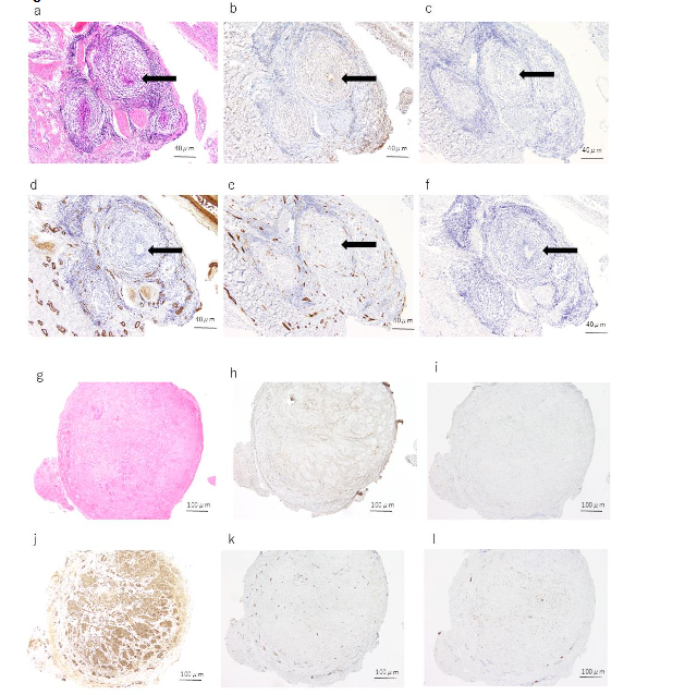 Figure 3. Histological and immunohistochemical findings of case 1. The solid arrow indicates the urachal lumen.