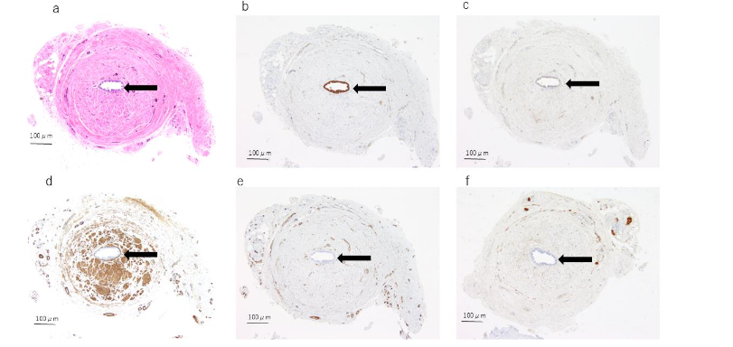 Figure 4. Histological and immunohistochemical findings of case 2. The solid arrow indicates the urachal lumen.