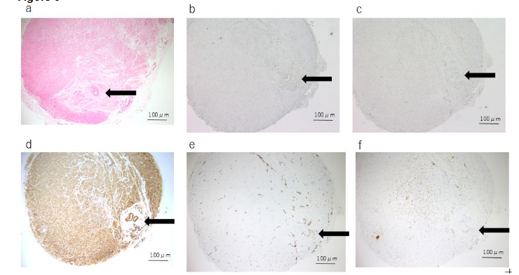 Figure 5. Histological and immunohistochemical findings of case 3. The solid arrow indicates the urachal lumen.