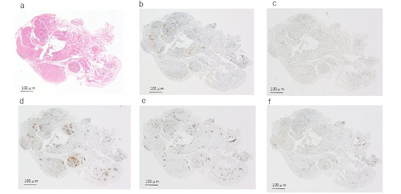 Figure 6. Histological and immunohistochemical findings of case 4. The solid arrow indicates the urachal lumen.