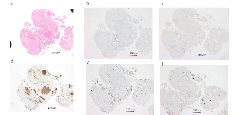 Figure 7. Histological and immunohistochemical findings of case 5. The solid arrow indicates the urachal lumen.