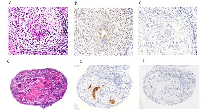 Figure 8. Comparison of keratin AE1/AE3 staining and epithelial membrane antigen staining.