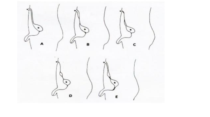 Figure 1. Classification system that categorizes urachal remnants into five types: Blichert-Toft et al. a. congenital patent urachus, b. umbilical urachal sinus c. vesicourachal diverticulum d. urachal cyst e. the alternating sinus, which develops as a result of infection of a urachal cyst.