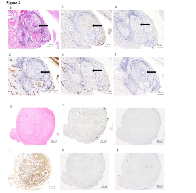 Figure 3. Histological and immunohistochemical findings of case 1. The solid arrow indicates the urachal lumen.