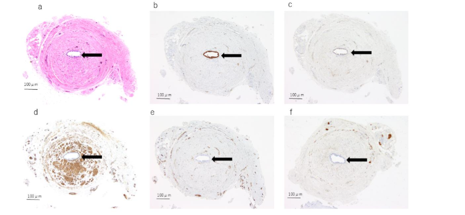Figure 4. Histological and immunohistochemical findings of case 2. The solid arrow indicates the urachal lumen.