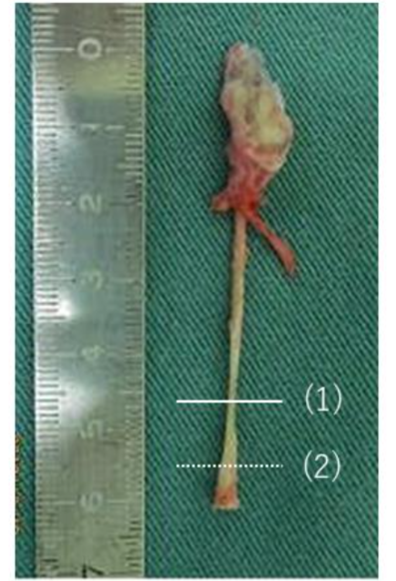 Figure 2. The excised specimen (case 1): Histological specimens were prepared from transverse sections of the tubular structure in each excised specimen. The solid line (1) indicates the section which showed evidence of tubular structure, and the dotted line (2) indicates the section which showed no evidence of tubular structure.