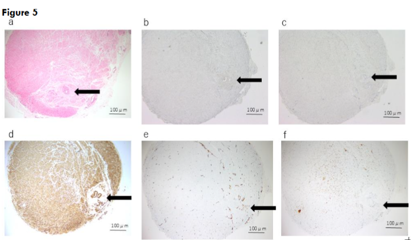 Figure 5. Histological and immunohistochemical findings of case 3. The solid arrow indicates the urachal lumen.