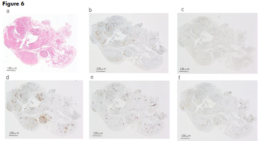Figure 6. Histological and immunohistochemical findings of case 4. The solid arrow indicates the urachal lumen.