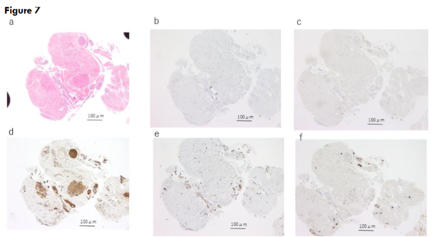 Figure 7. Histological and immunohistochemical findings of case 5. The solid arrow indicates the urachal lumen.