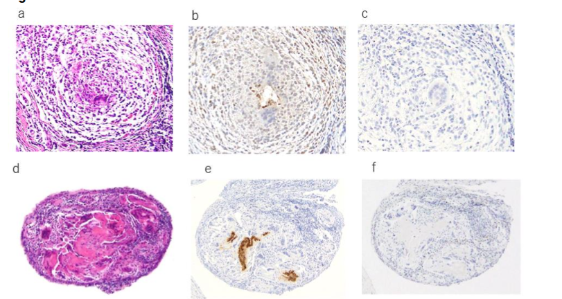 Figure 8. Comparison of keratin AE1/AE3 staining and epithelial membrane antigen staining. Two specimens contained cells that were stained with keratin AE1/AE3, although no distinct tubular structure was observed on HE staining; however, no EMA-positive cells were noted in these slices.