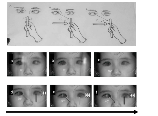Lateral Incomitance Horizontal Incomitance and Anisocoria in Esotropia - European Society ...