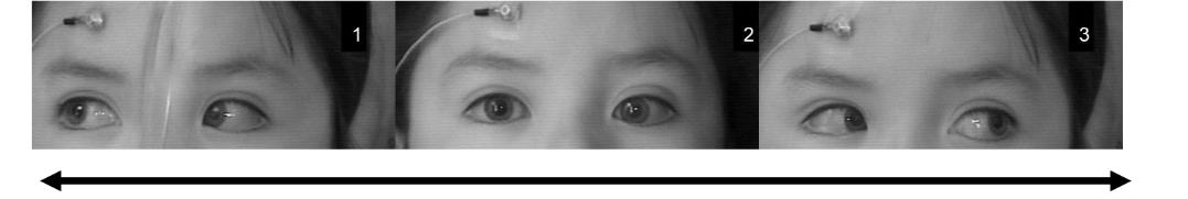 Lateral Incomitance Horizontal Incomitance and Anisocoria in Esotropia - European Society ...
