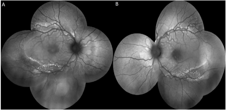 Figure 4: FAF showed increased number of hyper-autofluorescent flecks along the arcades and within the posterior pole OU (A, B).