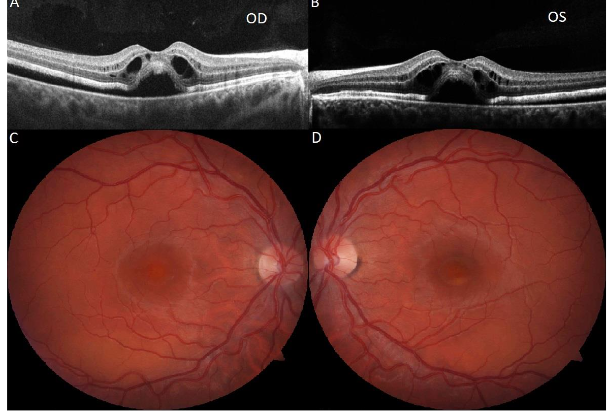 Figure 1: OCT showed SRF, IRC, and shallow NSD with a thickened RPE OU (A, B). Fundus photography showed vitelliform deposits inferior to the fovea OS with serous macular detachments OU (C, D).