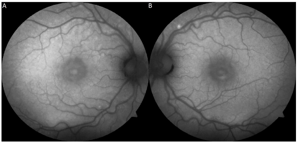 Figure 2: Fundus autofluorescence with patchy areas of hyper- and hypo-autofluorescence along the vascular arcades and macula OU (A, B).