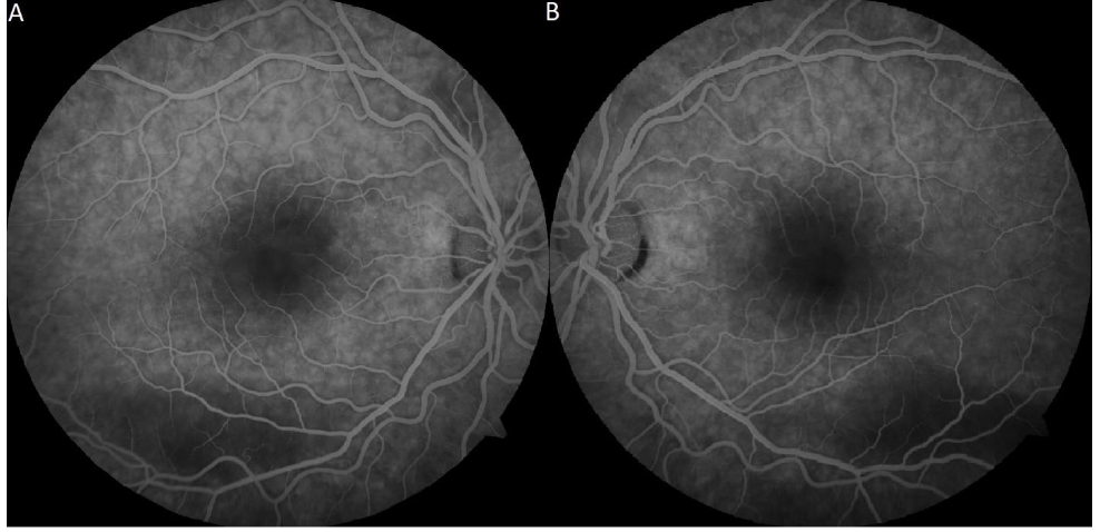 Figure 3: IVFA showed patchy choroidal filling, inferior hypofluorescence corresponding to areas of hypopigmented demarcation and thickened RPE OU, with hypofluorescence of the vitelliform lesion OS (A, B).