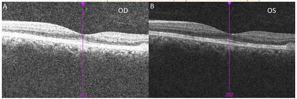 Figure 5: Interval OCT at 11 months showed resolution of SRF OU (A, B).