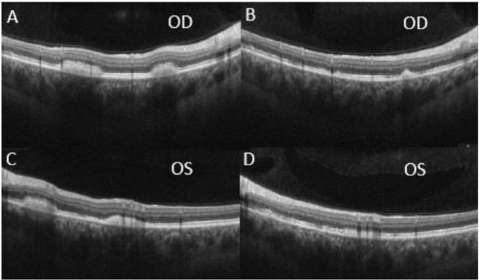 Figure 6: OCT of the macula at 15 months (A, C) and 17 months (B, D) showed improvements in the peripheral vitelliform lesions with correlated reductions in size.
