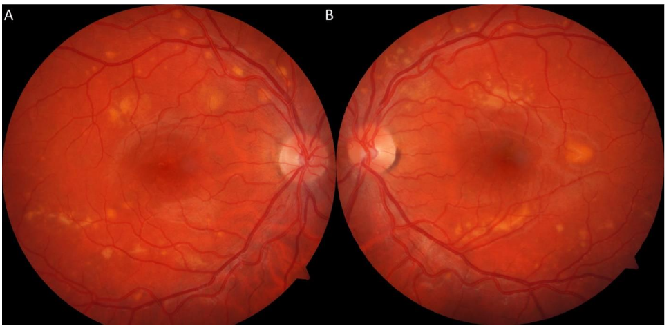 Figure 7: Repeat fundus photography at 1 year and 5 months showed resolved serous macular detachments OU, however with persistent vitelliform deposits along the vascular arcades OU (A, B).