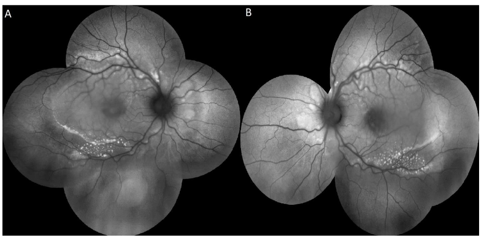 Figure 4: FAF showed increased number of hyper-autofluorescent flecks along the arcades and within the posterior pole OU (A, B).